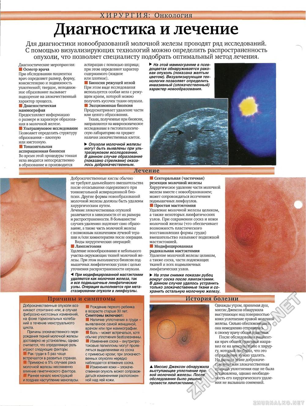 рак груди симптомы у женщин в менопаузе фото 29